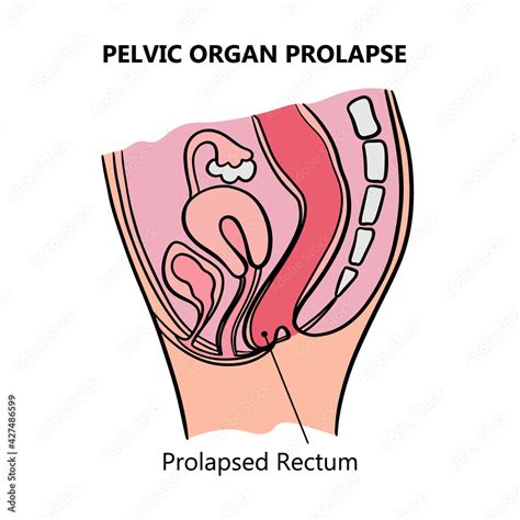 Prolapsed Rectum Of Women General Diagram With Explanatory Text For