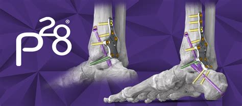 Paragon 28 Inc Increases Its Robust Ankle Fusion Plating Offering