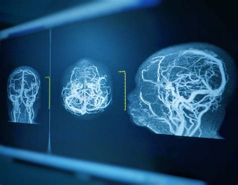 Derma Dream Neuronox Versus Botox In The Treatment Of Post Stroke