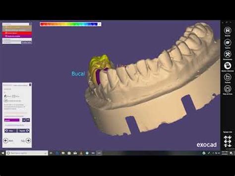 Proceso De Dise O Con Exocad Youtube