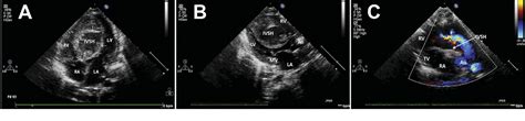 Figure From Interventricular Septal Hematoma After Congenital Cardiac