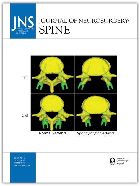 Long Term Clinical Outcomes Following 3 And 4 Level Anterior Cervical