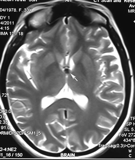 Radiodiagnosis Imaging Is Amazing Interesting Cases Colloid Cyst Mri