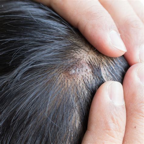 How to Prepare for a Scalp Biopsy - Miami Hair Institute