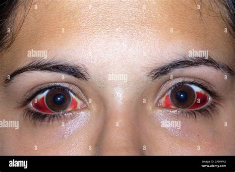 MODEL RELEASED Bleeding In The Eyes 16 Year Old Girl With Bleeding In