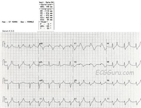 Hyperkalemia | ECG Guru - Instructor Resources