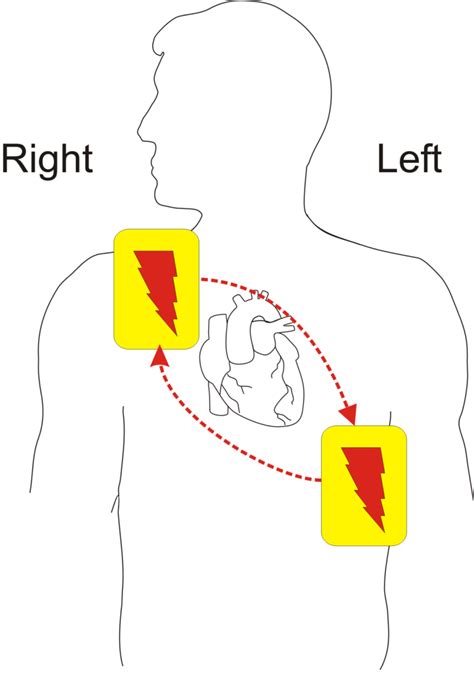 Defibelectrodeplacement Euro Medical And First Aid Ltd