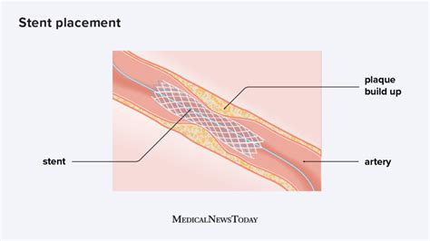 Stent placement: Types, procedures, risks, recovery – Cardiologist ...