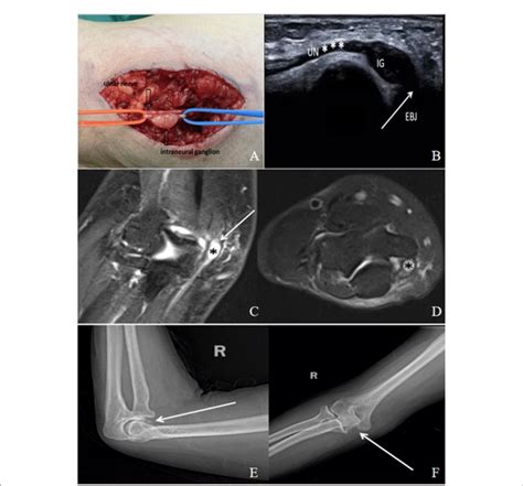 Figure E A Aa Year Old Male Patient With Cubital Tunnel Syndrome Caused