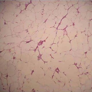 Low Power Image Of Scalp Nodule Showing Mature Adipose Cells With