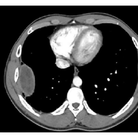 Chest X Ray Image Of The Extrapulmonary Intrathoracic Hydatid Cyst In