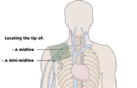 Midline Catheter Placement And Maintenance Protocol Peak Mobile