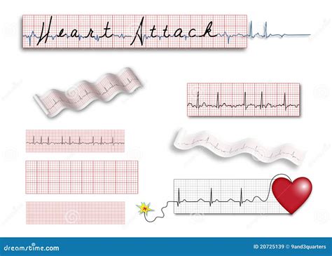 Full Page EKG Strips With Heart Attack Title Royalty Free Stock Images ...