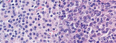 Note the frank plasmacytic differentiation with classic plasma cells ...