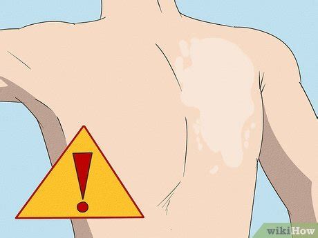 Icy Hot Rimuovere La Crema Dalla Pelle