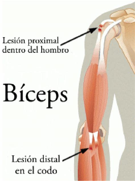 Lesiones Del Tend N Del B Ceps Braquial