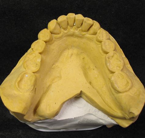 Bite Splint – FTI Dental Lab