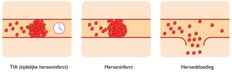 Beroerte Herseninfarct Of Hersenbloeding Tergooi MC