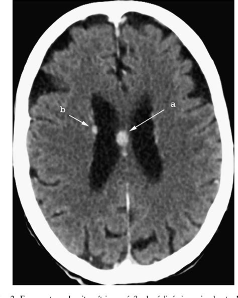 Lymphome cérébral primitif de la tige pituitaire Lymphoma of the