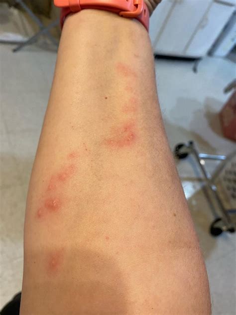 Skin Rash From Virginia Creeper Vine Walter Reeves The Georgia Gardener