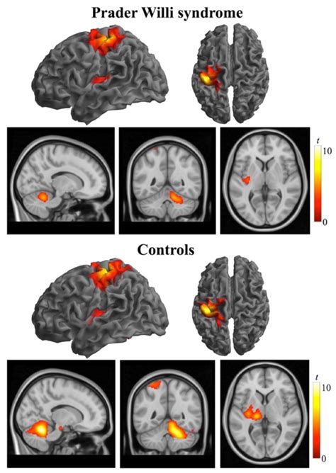 Cerebellar Dysfunction in Adults with Prader Willi Syndrome