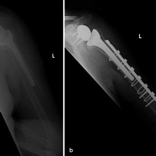 Plain Ap Radiograph Showing Type B Periprosthetic Fracture Of Left