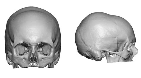 Plastic Surgery Case Study - Custom Skull Implant Correction of a ...