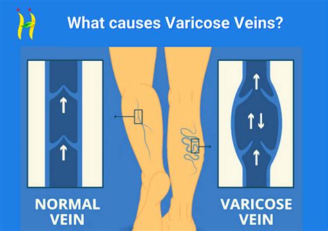 All You Need To Know About Varicose Veins By The Hale Clinic Bangalore Medium