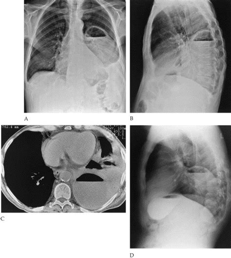 Intrathoracic Stomach Or Empyema The Annals Of Thoracic Surgery