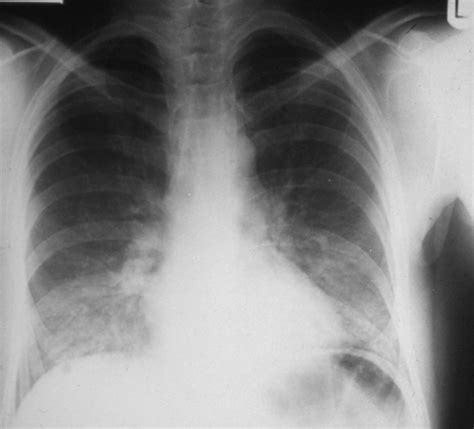 Pneumocystis Pneumonia Life Worldwide