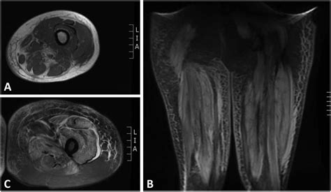 MRI imaging studies of the thigh muscles. A, Axial T1-weighted images... | Download Scientific ...