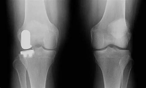 Robotic Knee Replacement Procedures New York S Best Knee Replacement