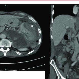 Abdominal CT scan showing a pancreatic pseudocyst of 11 cm × 8 cm... | Download Scientific Diagram