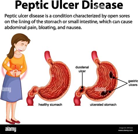 Enfermedad de úlcera péptica Ilustración infográfica Imagen Vector de