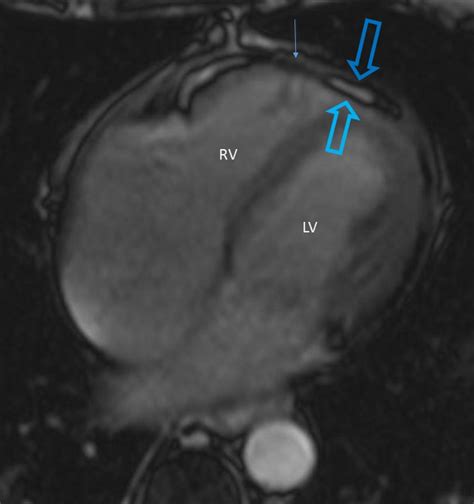 Constrictive Pericarditis Mri