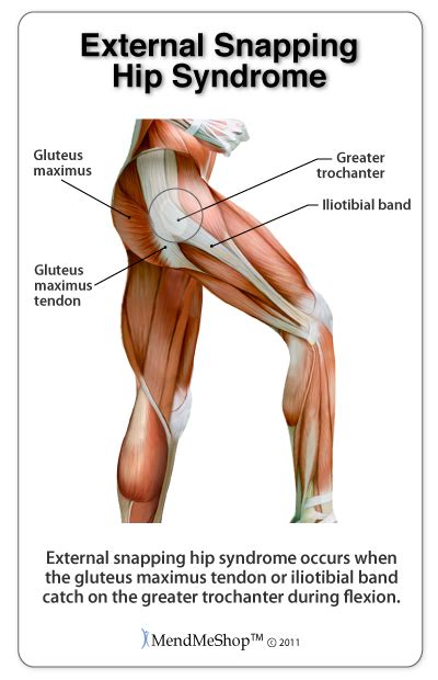 Hip Flexor Strain Tear