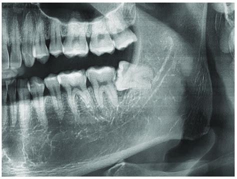 Patient 1801222 With A Y Sign Corresponding To Wisdom Tooth 38 In The