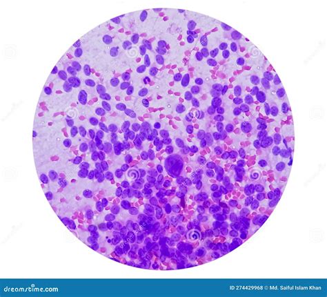 Liver SOL Cytology Showing Non Hodgkin Lymphoma Metastatic Carcinoma