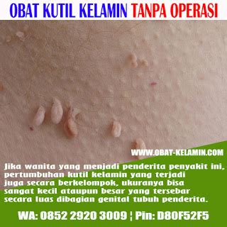 Fakta Tentang Obat Kutil Kelamin Di Apotik Salepkutilkelamin