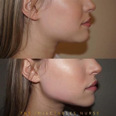 Jawline Fillers - HealthMedline