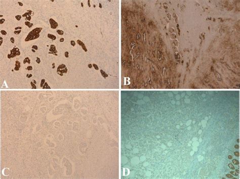 Photomicrograph A Immunostaining Showing CK7 Positivity In Tumour Cell