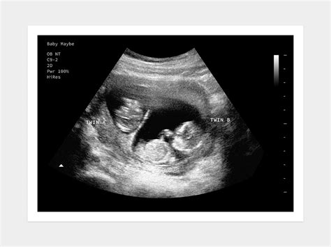 12 Weeks Twins | Fake Ultrasound w/ Instant Download!