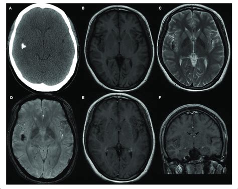 | (A) The Computed tomography demonstrated the calcification in right... | Download Scientific ...