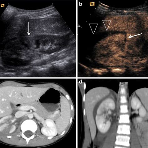 Ii Grade Renal Injury In A 9 Year Old Girl A At Baseline Us Is Visible