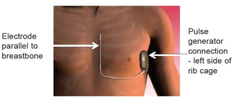 How Icds And S Icds Work Boston Scientific