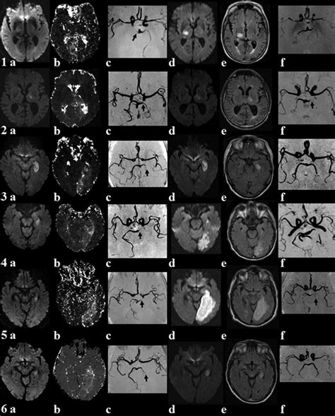 MR imaging in posterior circulation stroke before (ac) and after (df ...