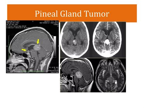 Intracranial Space Occupying Lesions Ppt