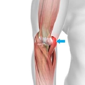 Hyperextension Injury of the Elbow Montgomery, AL | Elbow Dislocation ...