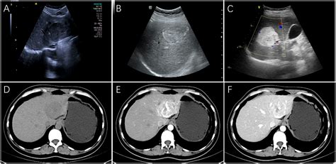 Frontiers Hepatic Perivascular Epithelioid Cell Tumor A