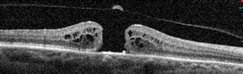 Macular Hole | Conditions | Retina Center of Texas